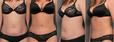 Tummy Tuck before and after photo