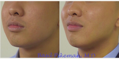 Buccal Fat Removal before and after photo