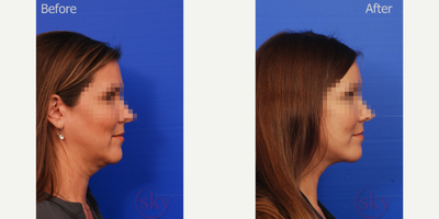 Facelift before and after photo