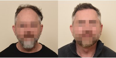 FUE Hair Transplant before and after photo