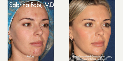 IPL before and after photo