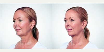 Kybella before and after photo