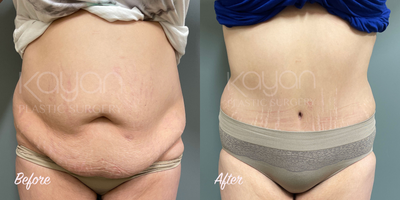 Tummy Tuck before and after photo