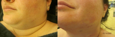 Vaser Liposuction before and after photo