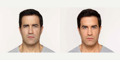 Botox before and after photo