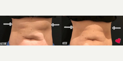 CoolSculpting before and after photo