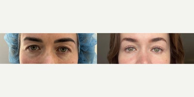 Double Eyelid Surgery before and after photo