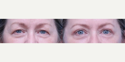 Eyelid Surgery before and after photo