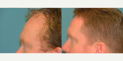 Hair Transplant before and after photo