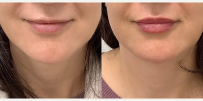 Lip Fillers before and after photo