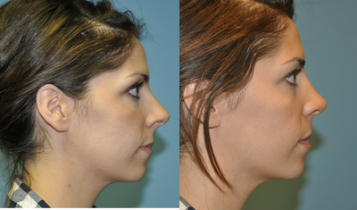 Rhinoplasty before and after photo