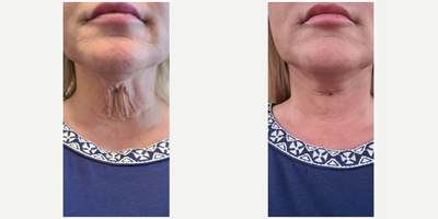 Skin Tightening before and after photo