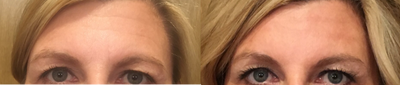Volbella before and after photo