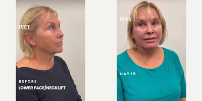 Facelift before and after photo
