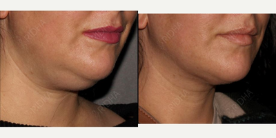 Liposuction before and after photo