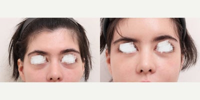 Nonsurgical Facelift before and after photo