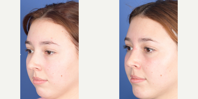 Rhinoplasty before and after photo