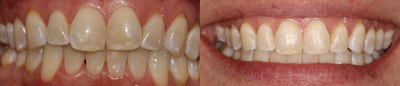 Clear Braces before and after photo