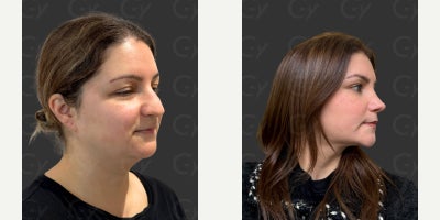 Eyelid Surgery before and after photo