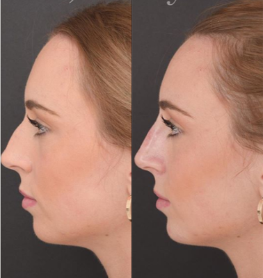 Juvederm before and after photo