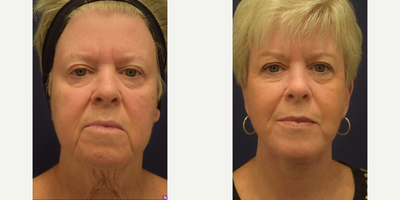 Lower Facelift before and after photo