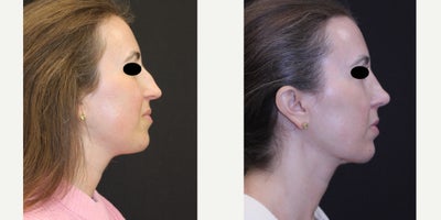 Rhinoplasty before and after photo