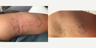 Tattoo Removal before and after photo