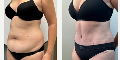 Tummy Tuck before and after photo