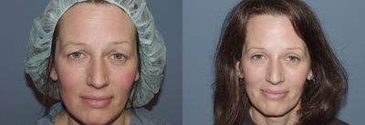Eyelid Surgery before and after photo