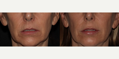 Lip Fillers before and after photo