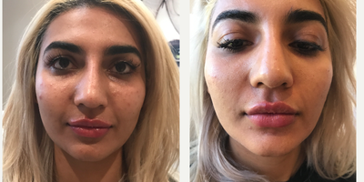 Botox before and after photo