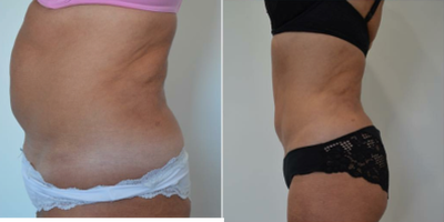 CoolSculpting before and after photo