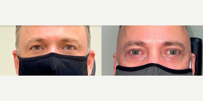 Eyelid Surgery before and after photo