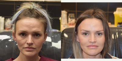 Botox before and after photo