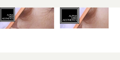Botox before and after photo