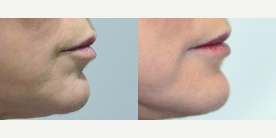 CO2 Laser before and after photo