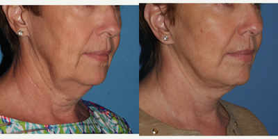 Facelift before and after photo