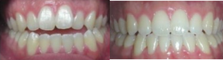 Invisalign before and after photo