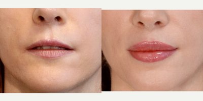Lip Surgery before and after photo