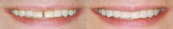 Lumineers before and after photo