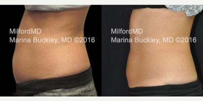CoolSculpting before and after photo