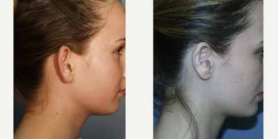 Ear Surgery before and after photo