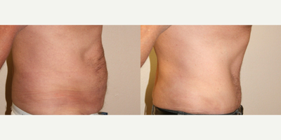 Male Tummy Tuck before and after photo