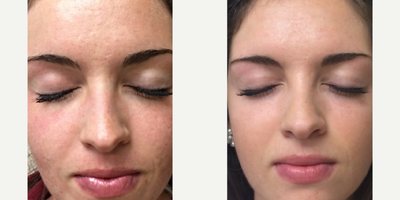 Microneedling before and after photo