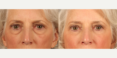 Eyelid Surgery before and after photo