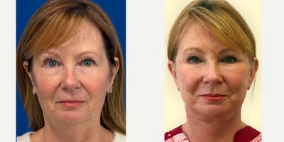 Eyelid Surgery before and after photo