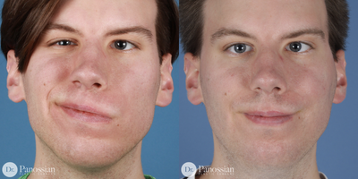 Facial Reconstructive Surgery before and after photo