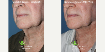 Neck Lift before and after photo
