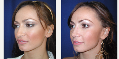 Rhinoplasty before and after photo