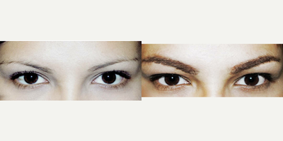 Eyebrow Transplant before and after photo